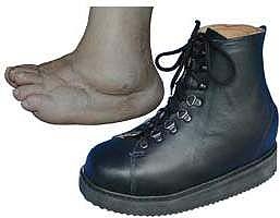 ortopedická obuv pre ťažko postihnutú nohu zhotovená podľa sádrového odtlačku